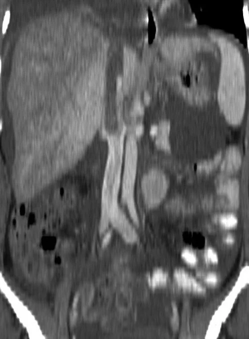BEHCET DISEASE + BUDD CHIARI SYNDROME