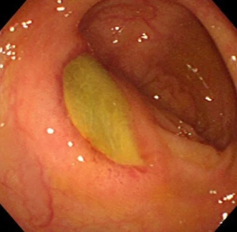 BEHCET'S DISEASE - ULCER TRANSVERSE COLON