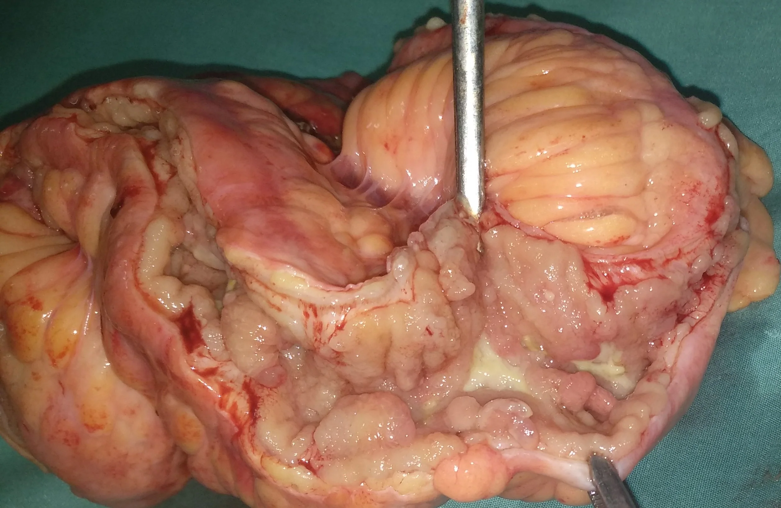 CROHN'S ILEITIS