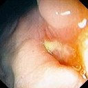 CROHN'S DISEASE - RECTOVAGINAL FISTULA
