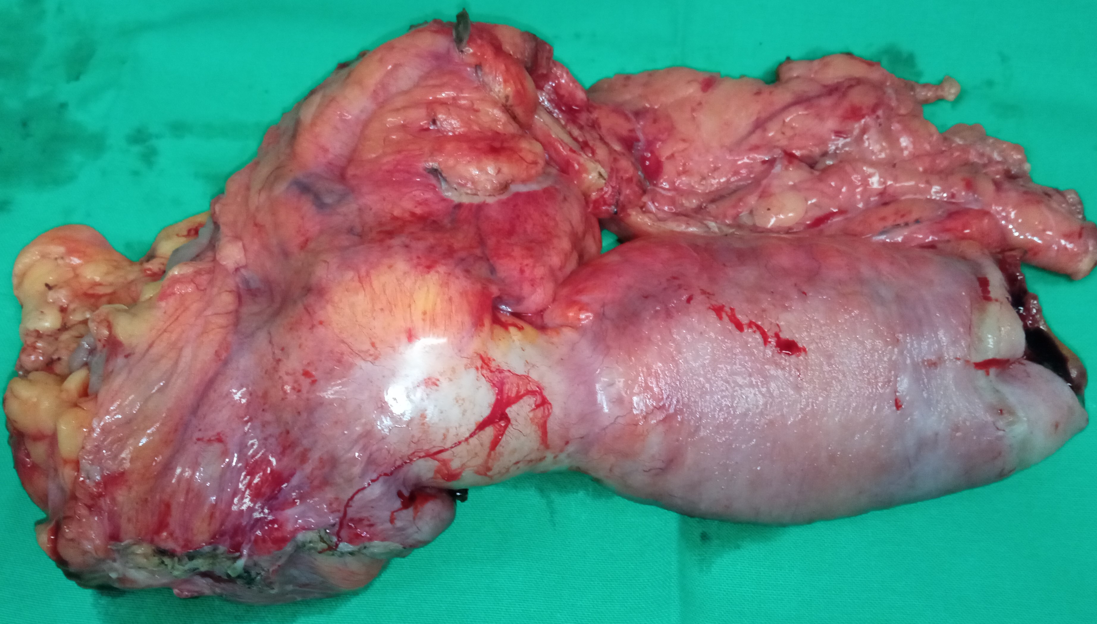 CROHN'S DISEASE - STENOSIS ILEOCOLIC ANASTOMOSIS