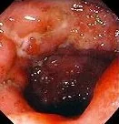 CROHN'S COLITIS