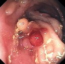 CROHN'S FISTULA