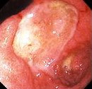 GASTRODUODENAL CROHN'S DIASEASE