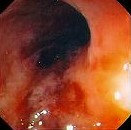 CROHN'S  ILEITIS 