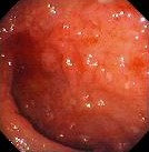 CROHN'S ILEOCOLITIS 