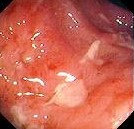 CROHN'S ILEOCOLITIS