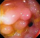 CROHN'S ILEOCOLITIS