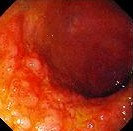 MUCOSAL CHANGES - CROHN'S DISEASE