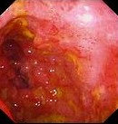 MUCOSAL CHANGES - CROHN'S DISEASE