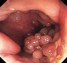 MUCOSAL CHANGES - CROHN'S DISEASE