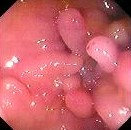 MUCOSAL CHANGES - CROHN'S DISEASE