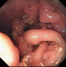 MUCOSAL CHANGES - CROHN'S DISEASE