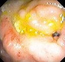 CROHN'S DISEASE - RECTOVAGINAL FISTULA