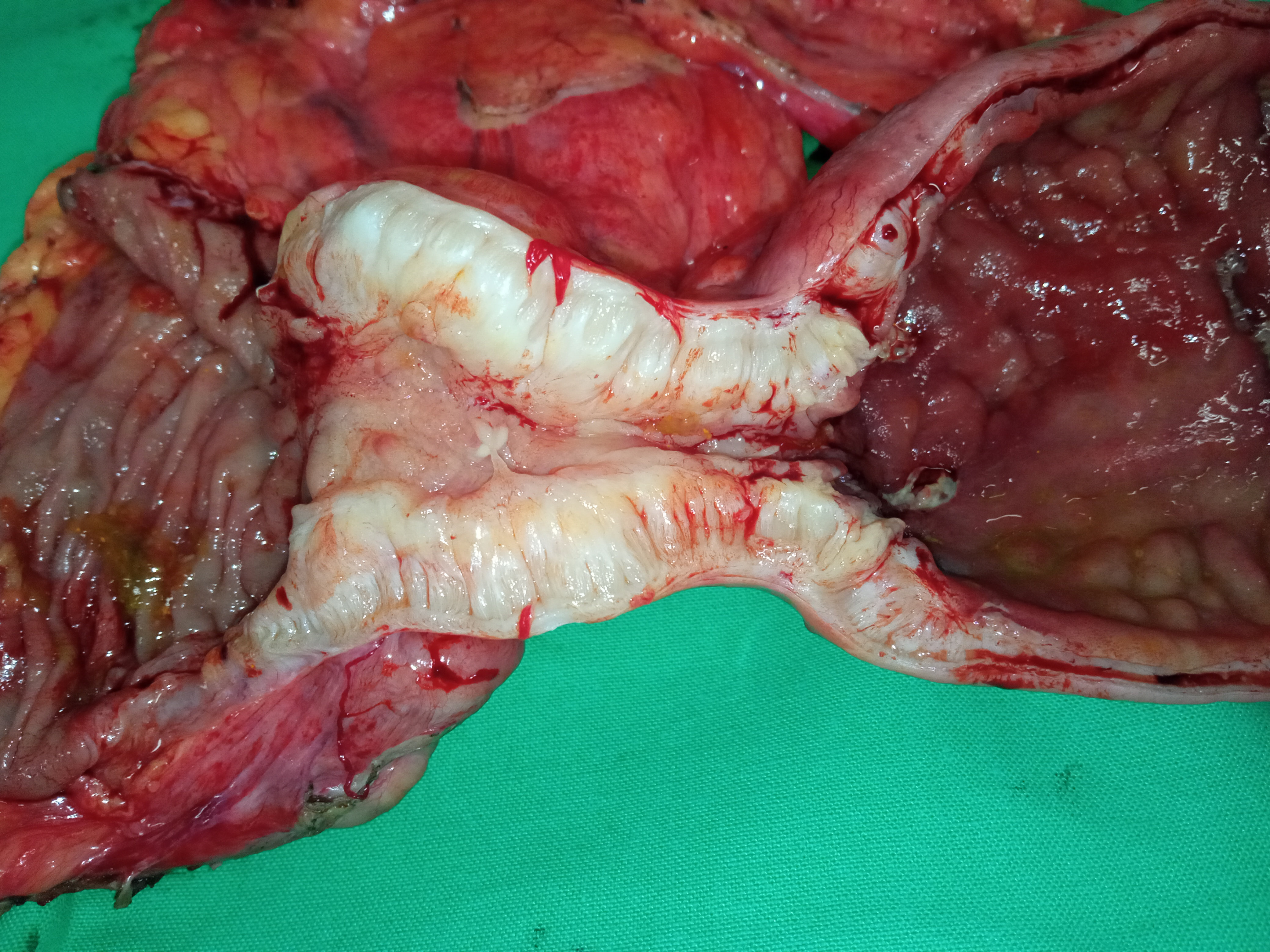 ILEAL STENOSIS - CROHN'S DISEASE