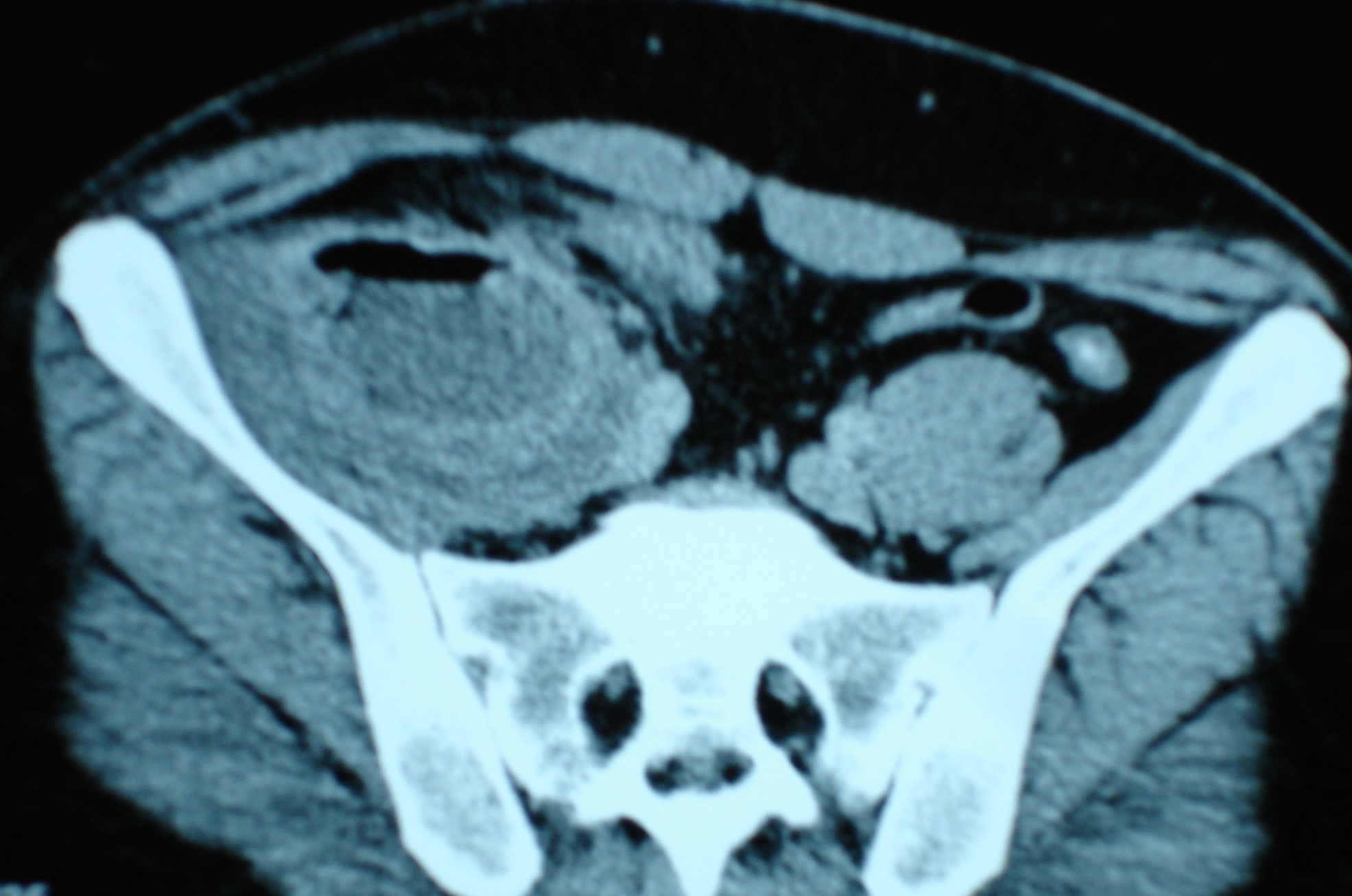 CROHN'S DISEASE - RETROPERITONEAL ABSCESS