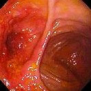 ANASTOMOTIC CROHN'S DISEASE