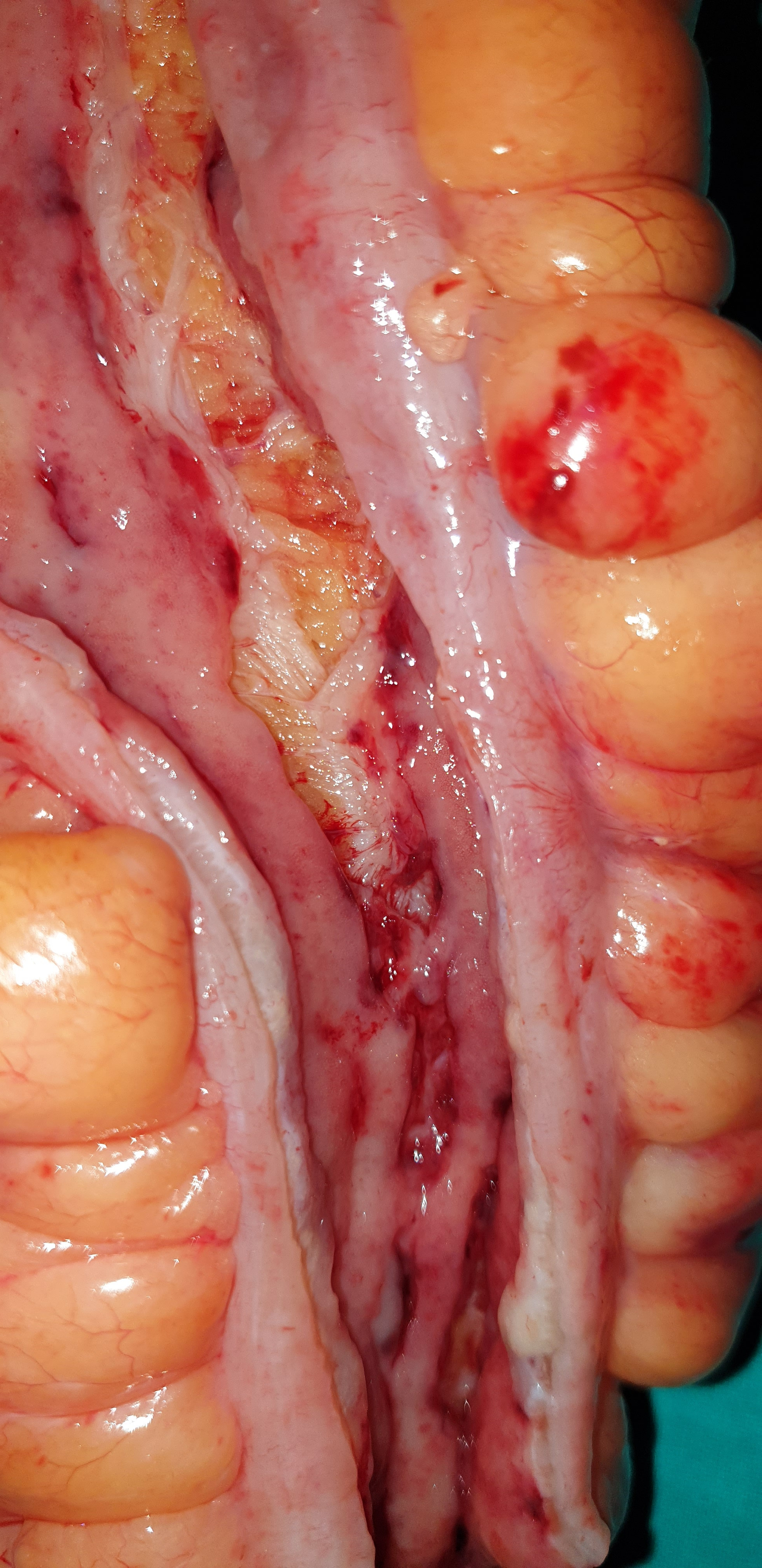 CROHN'S COLITIS