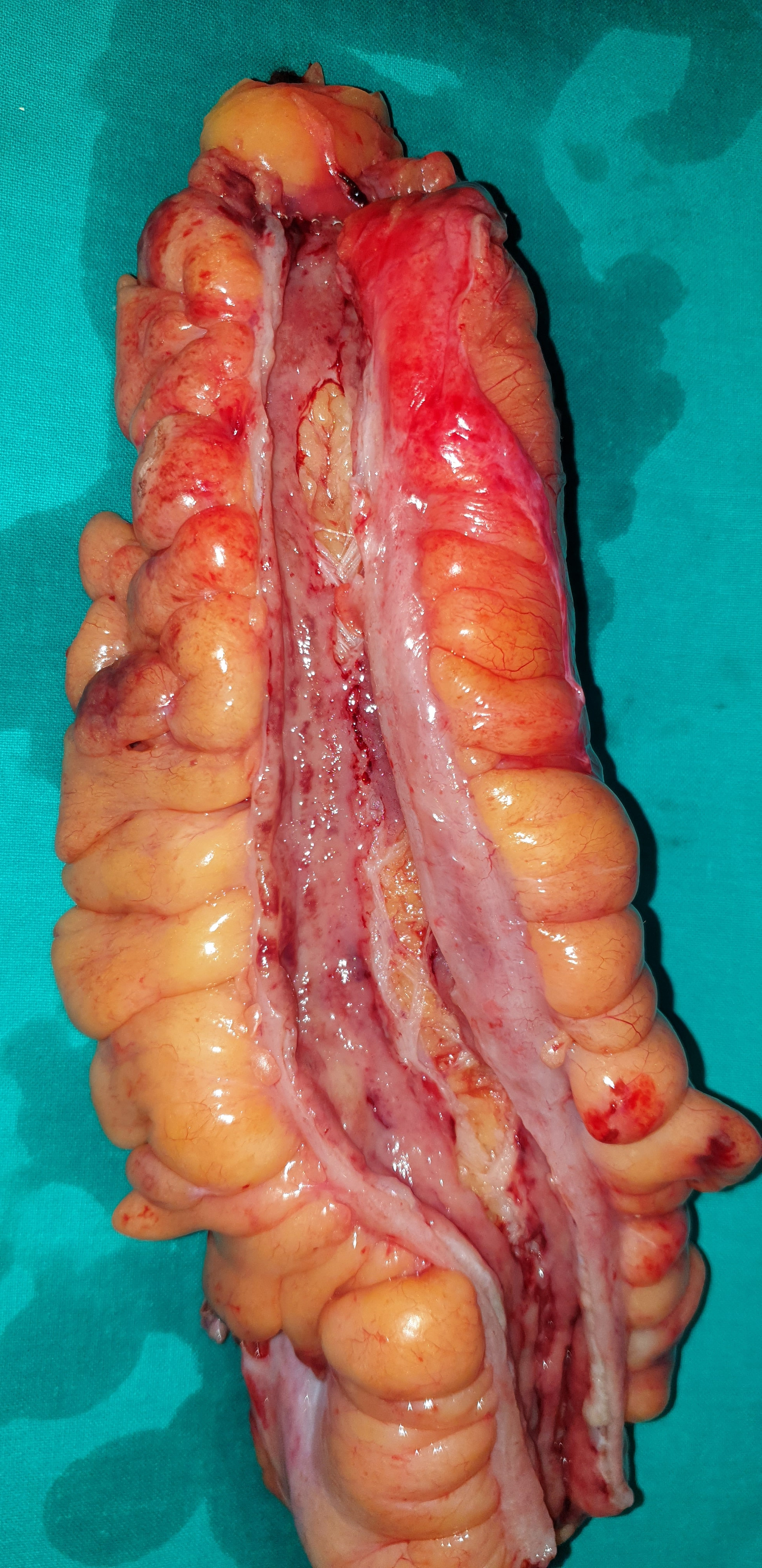 CROHN'S COLITIS