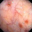 CROHN'S COLITIS