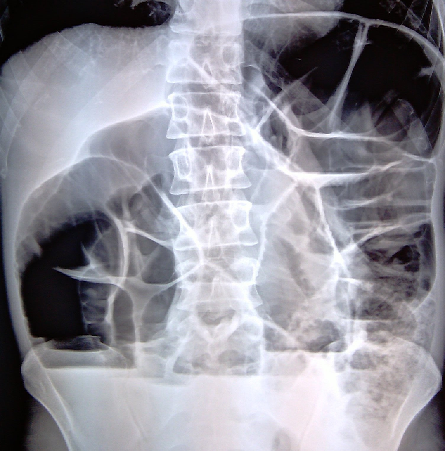 ILEUS - CROHN'S DISEASE