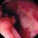 MUCOSAL CHANGES - CROHN'S DISEASE