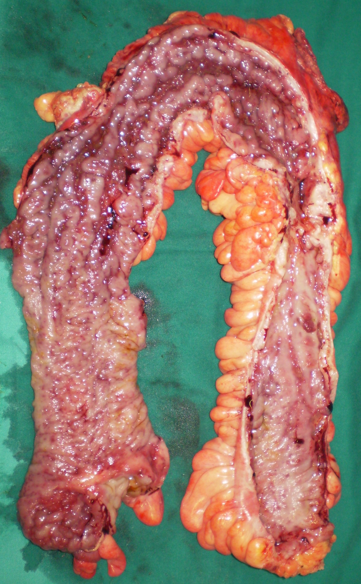 CROHN PANCOLITIS