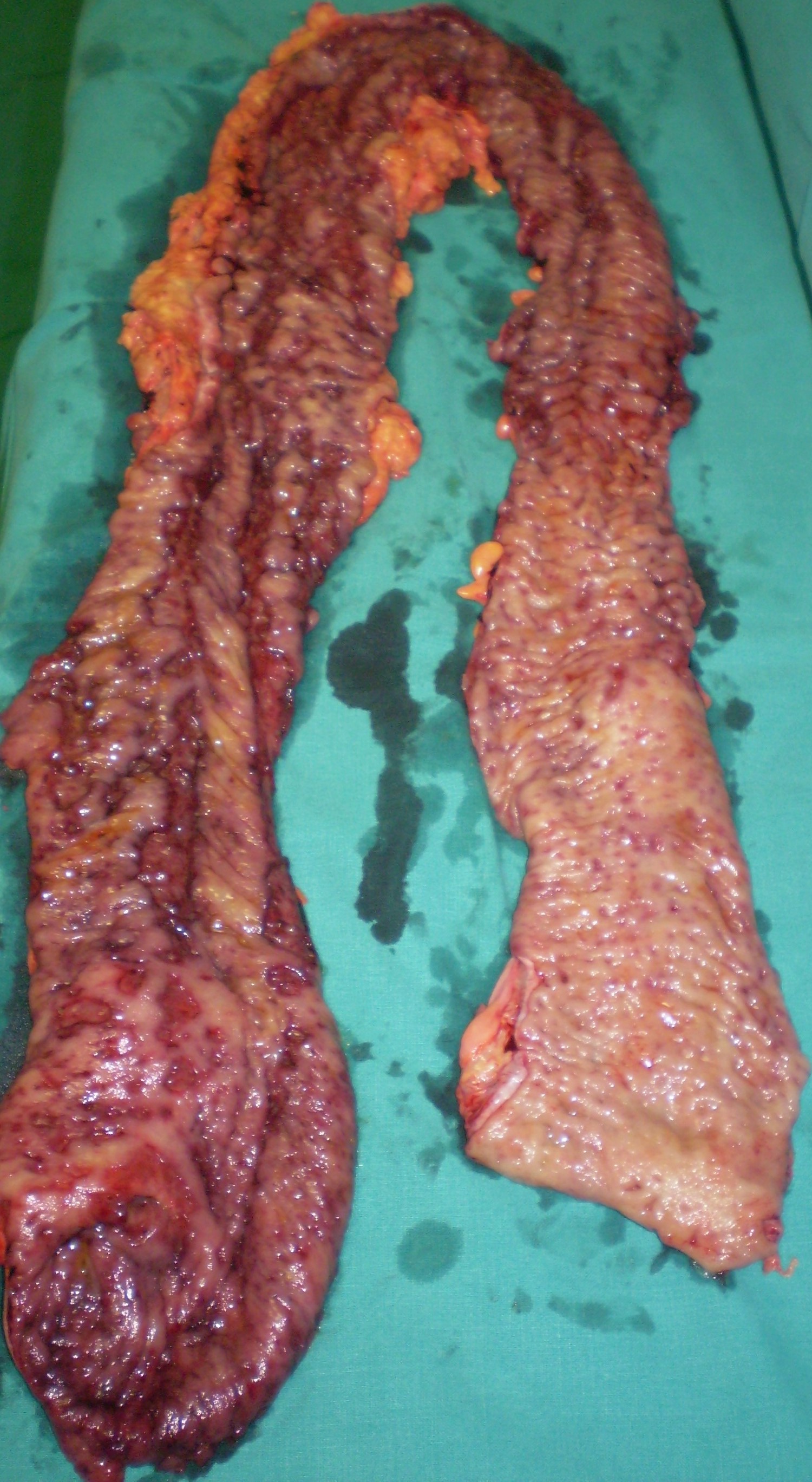 CROHN PANCOLITIS