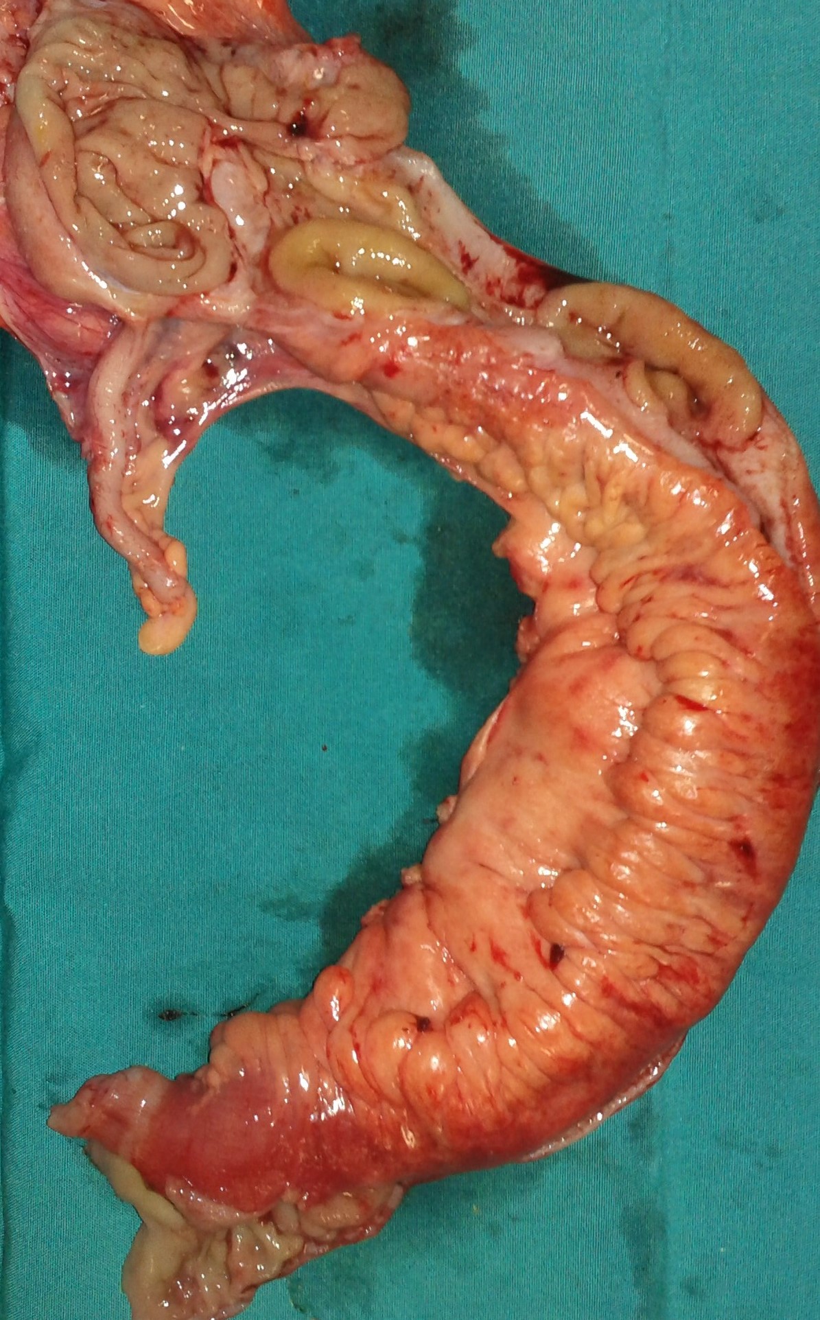 TERMINAL ILEITIS