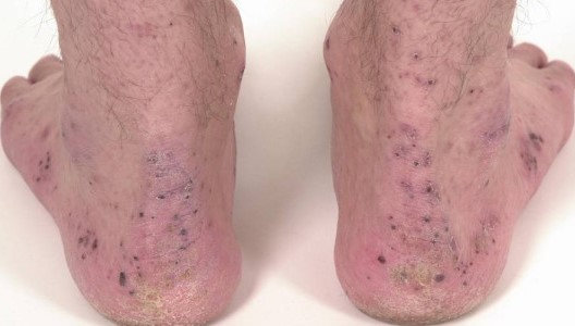 CROHN'S DISEASE - ARTHRITIS