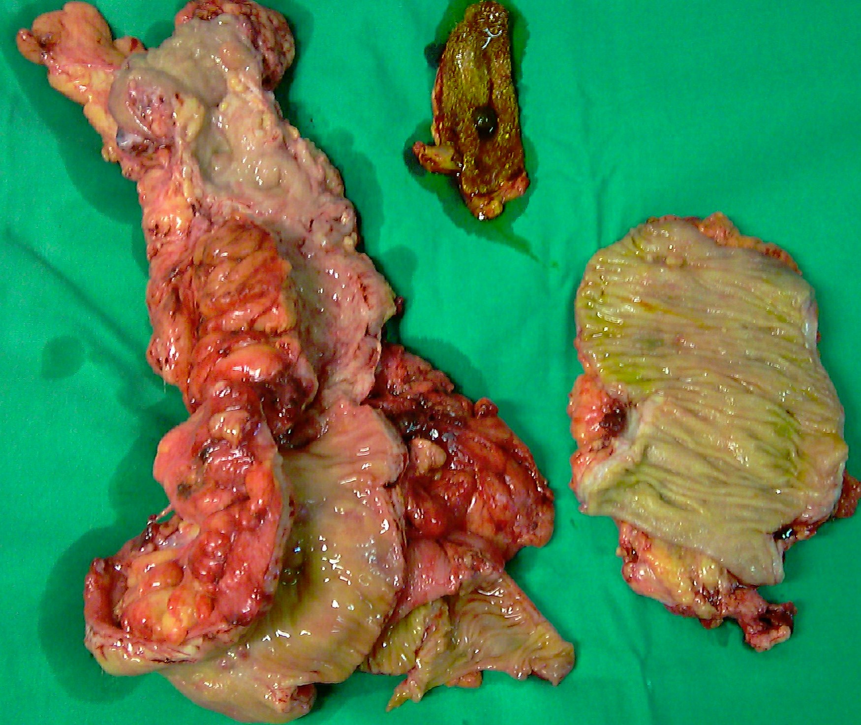 CROHN'S DISEASE - ENTERECTOMY
