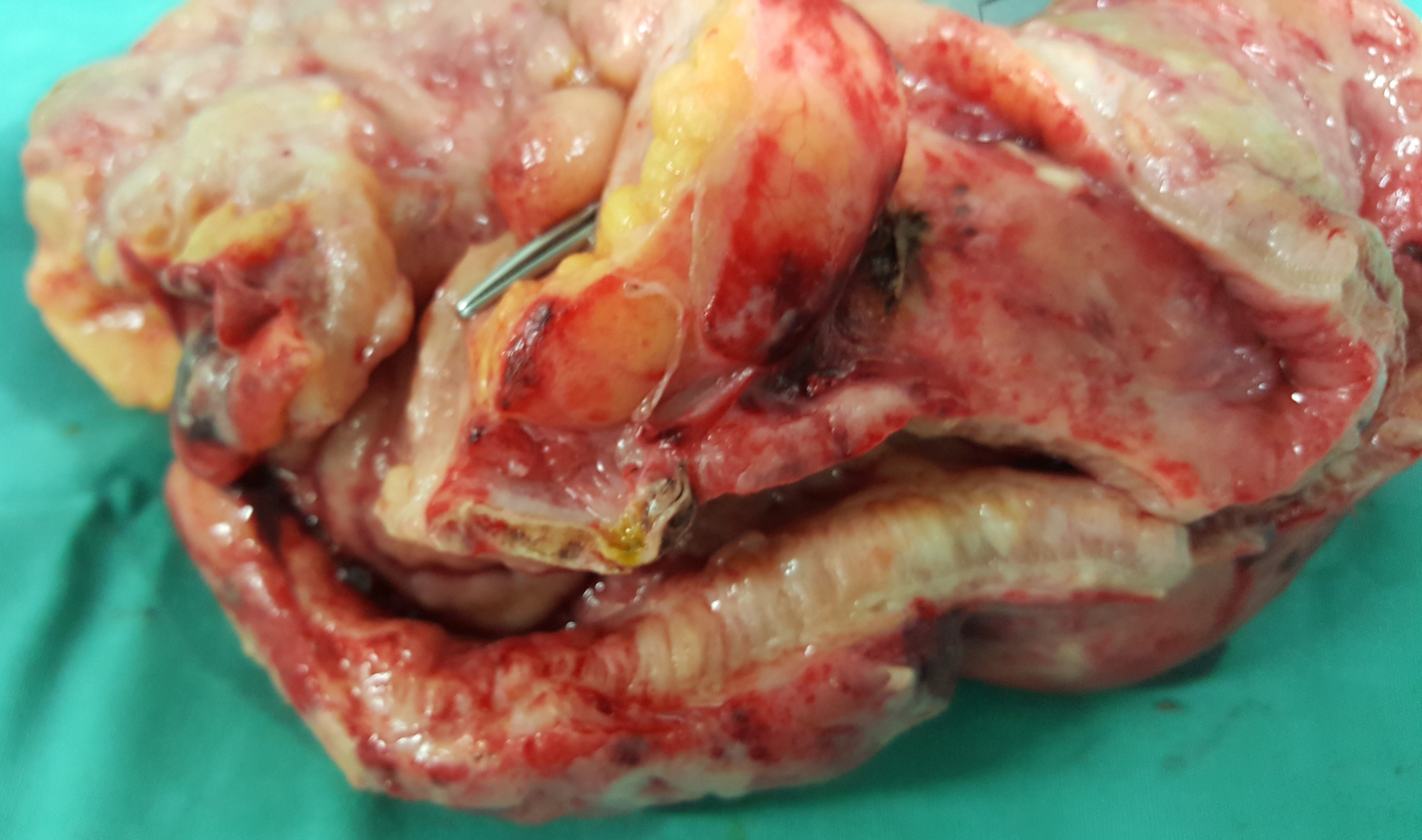 CROHN'S DISEASE - ENTERECTOMY