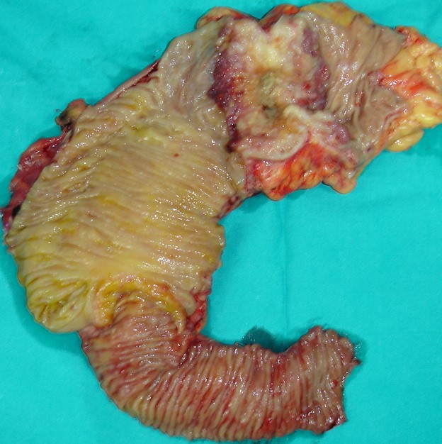 CROHN'S DISEASE + COLONIC CARCINOMA