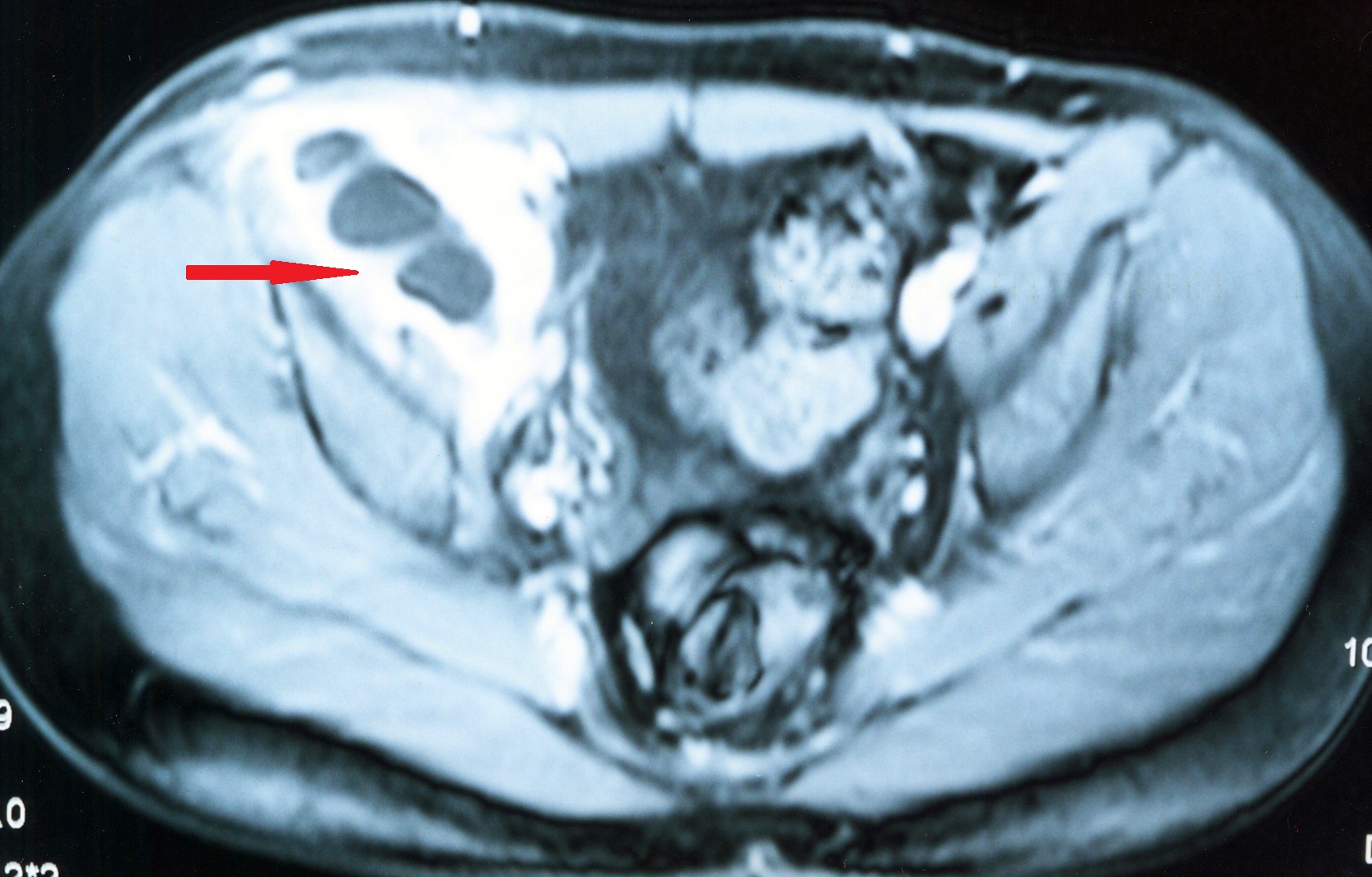 CROHN'S  ABSCESS