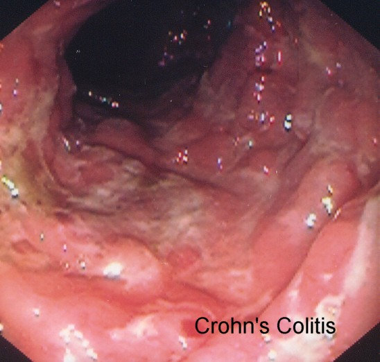 CROHN'S COLITIS