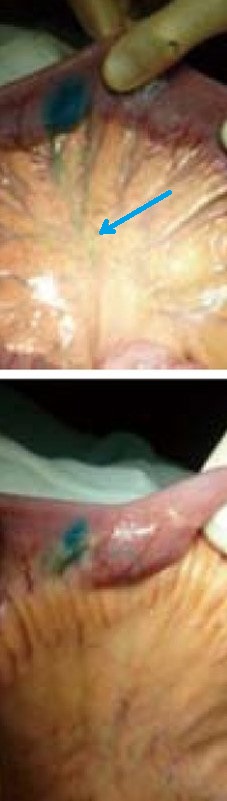 CROHN'S DISEASE-METHYLENE BLUE INJECTION