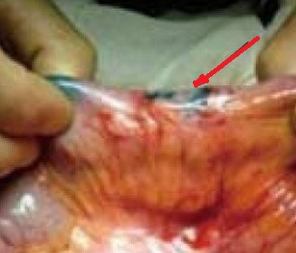 CROHN'S DISEASE-METHYLENE BLUE INJECTION