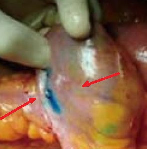CROHN'S DISEASE-METHYLENE BLUE INJECTION