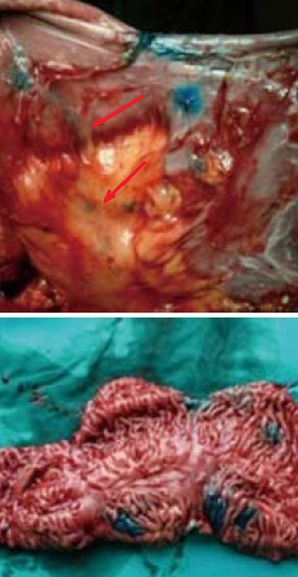 CROHN'S DISEASE-METHYLENE BLUE INJECTION