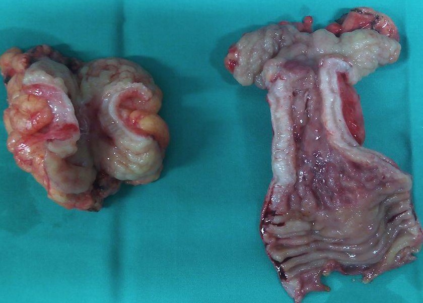 CROHN'S DISEASE - ENTERECTOMY + COLECTOMY