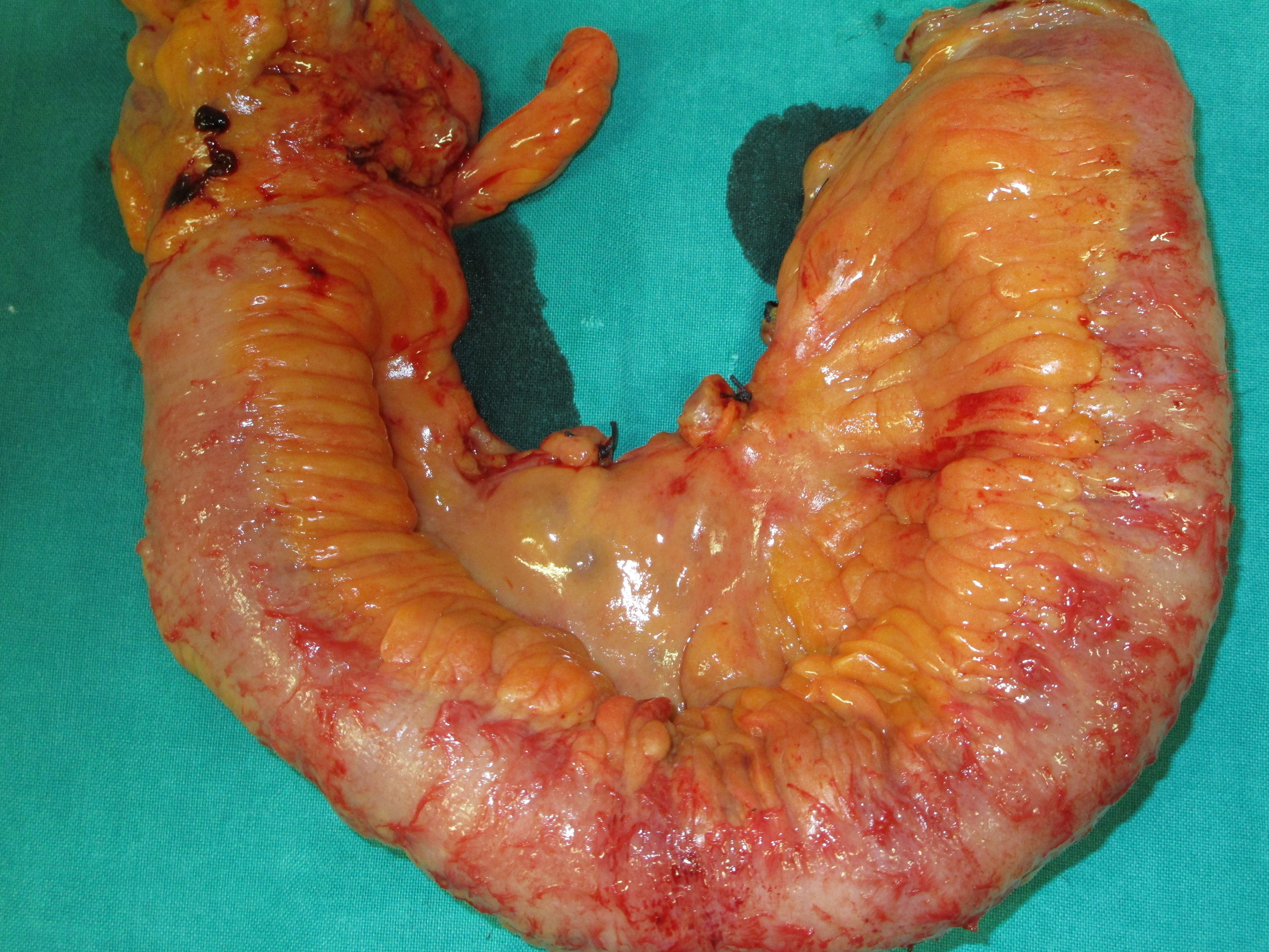 CROHN'S DISEASE - ENTERECTOMY
