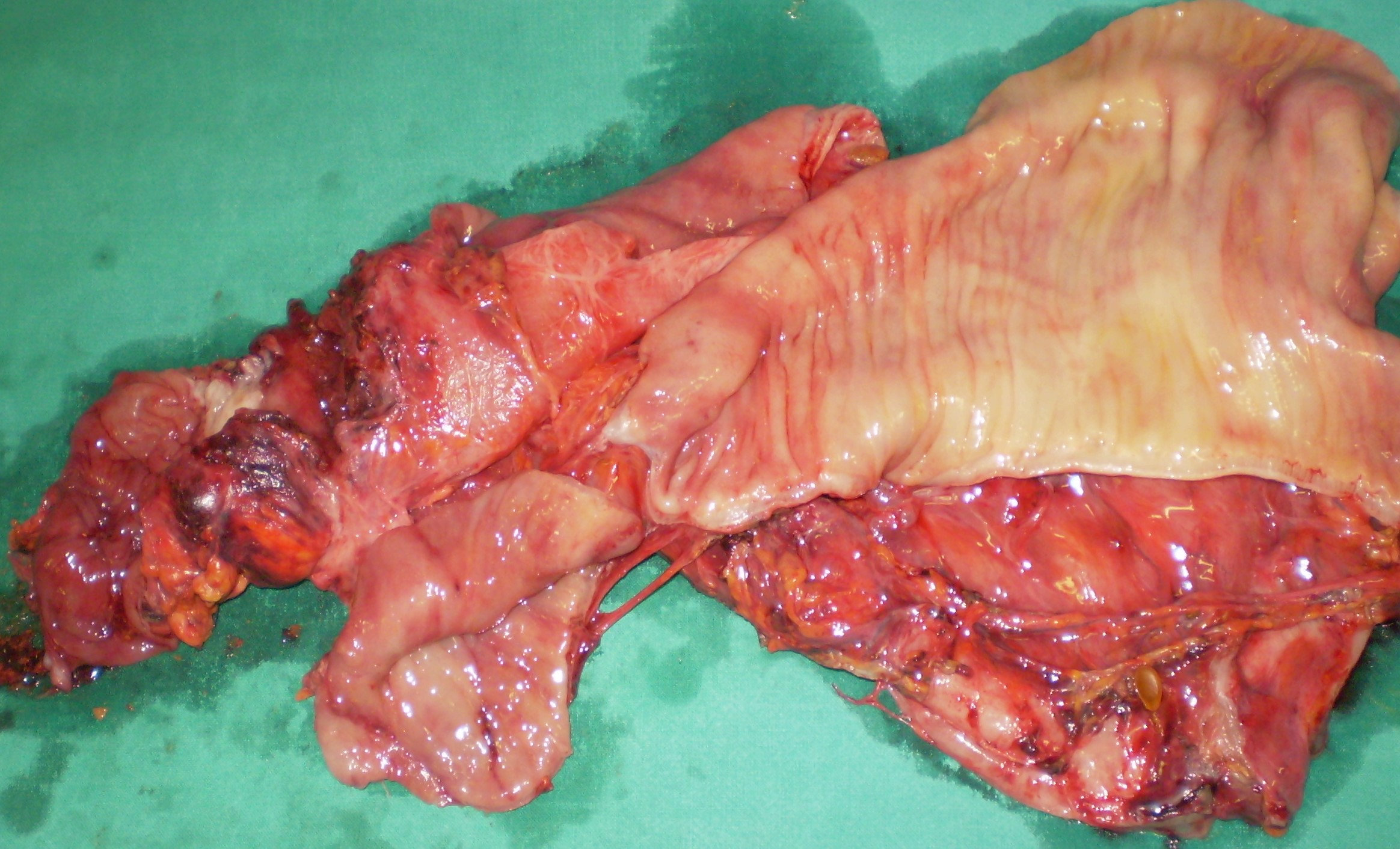 CROHN'S DISEASE - ENTEROCOLIC FISTULA