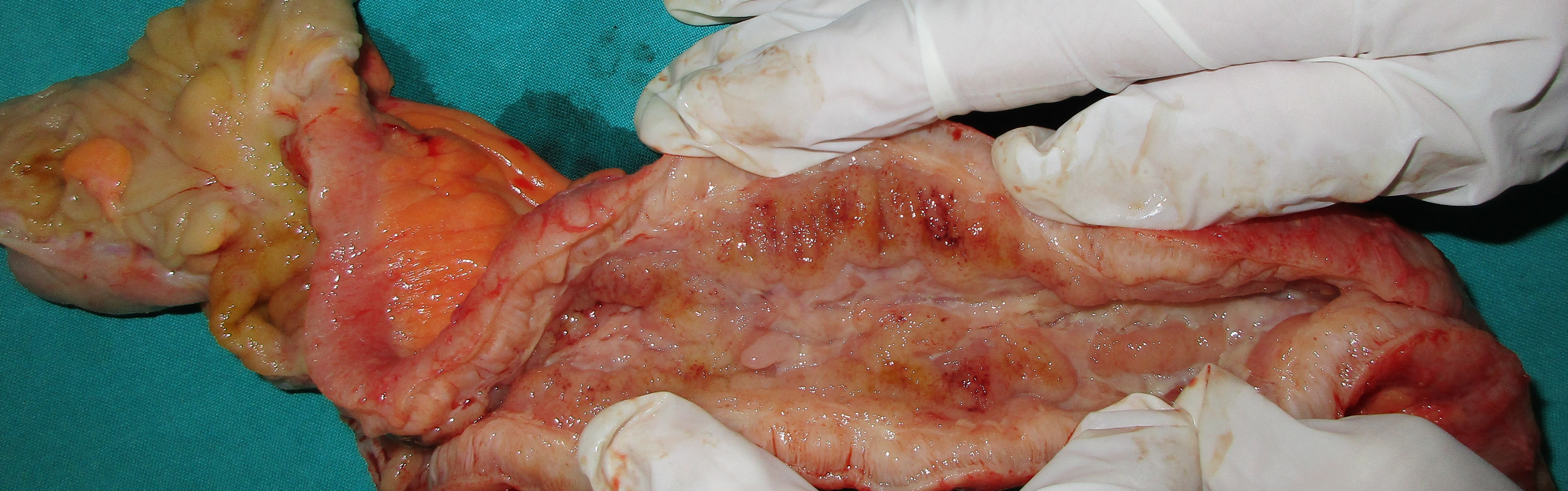CROHN'S DISEASE - INTESTINAL STENOSIS
