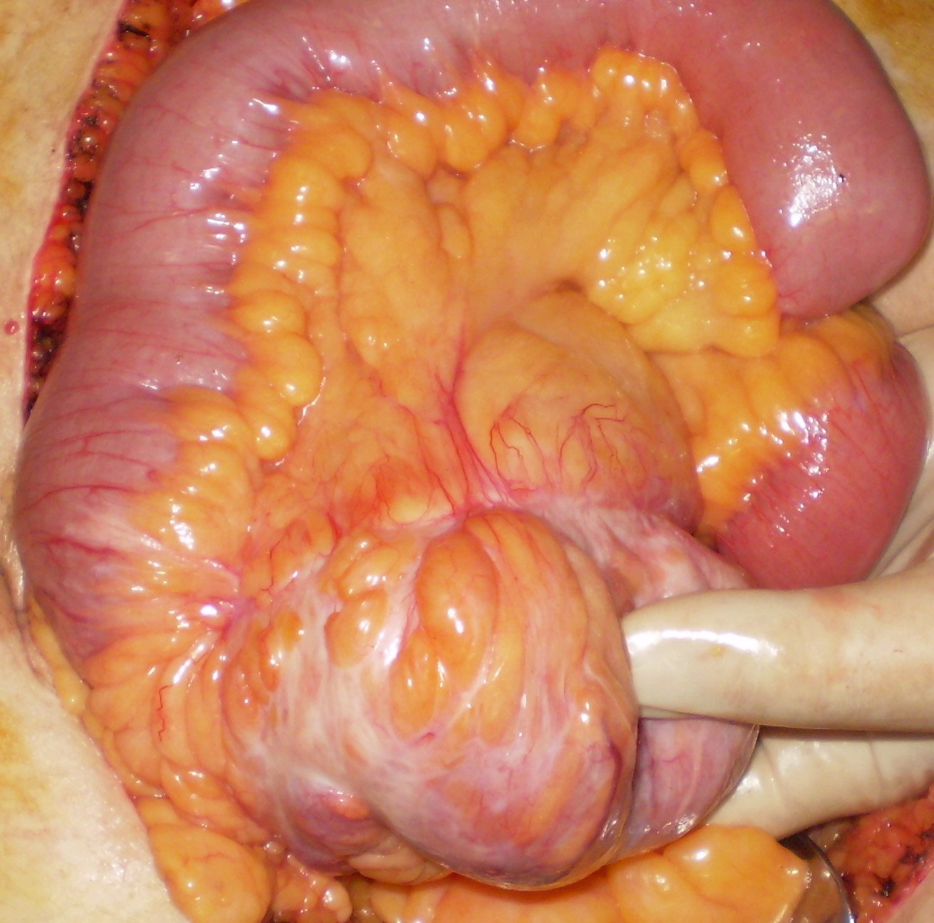 CROHN'S DISEASE