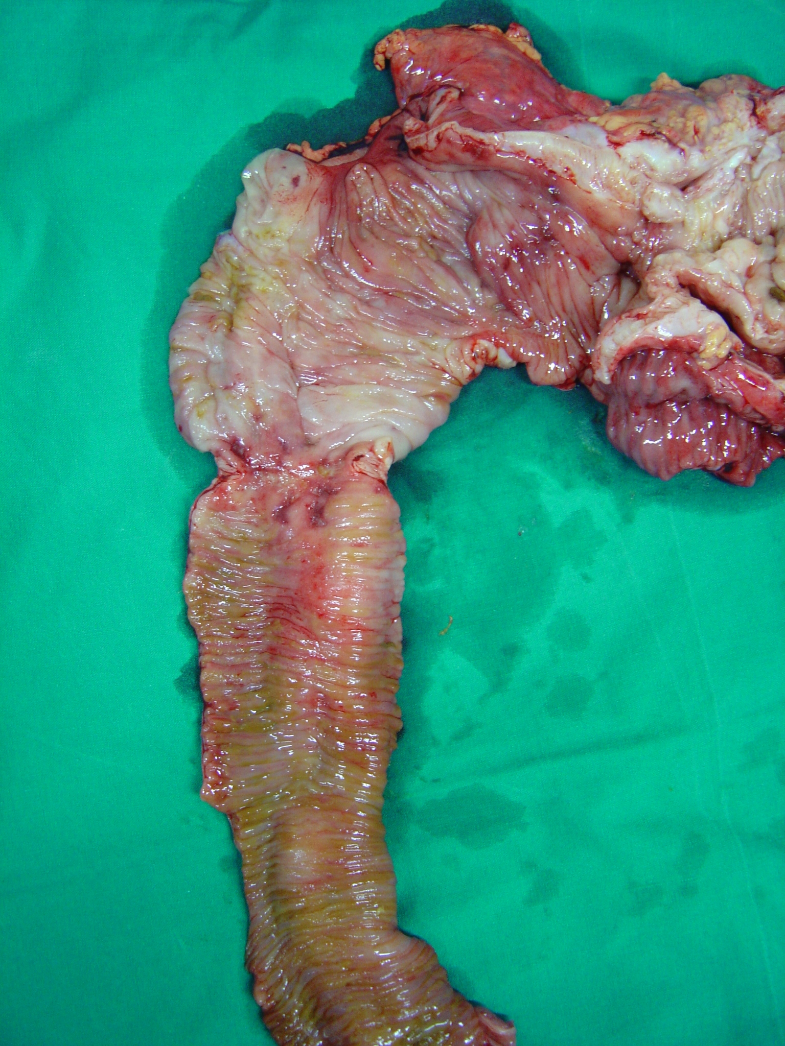 RECURRENCE CROHN'S DISEASE