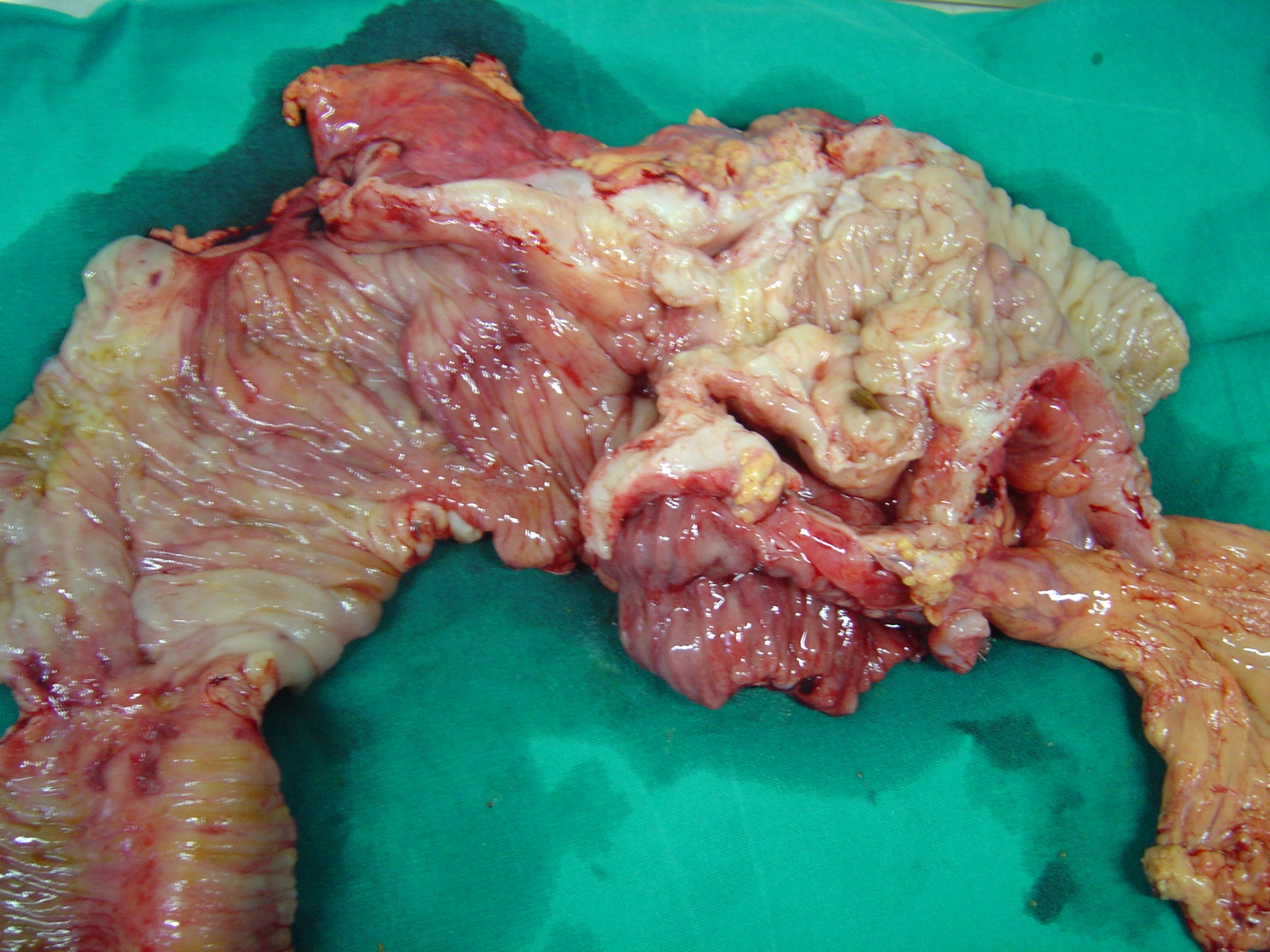 RECURRENCE CROHN'S DISEASE