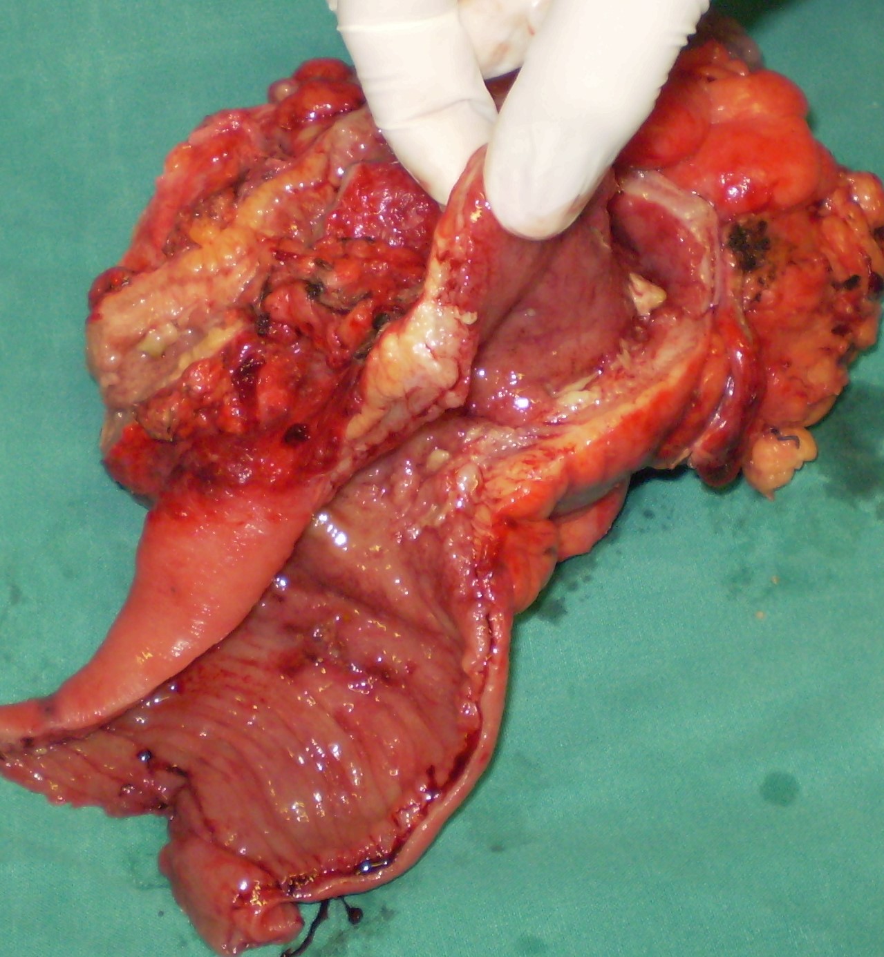 CROHN'S DISEASE