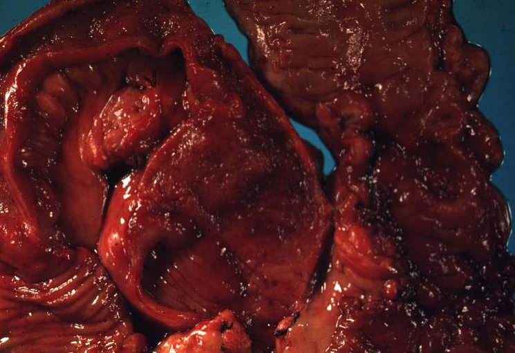 CROHN'S DISEASE