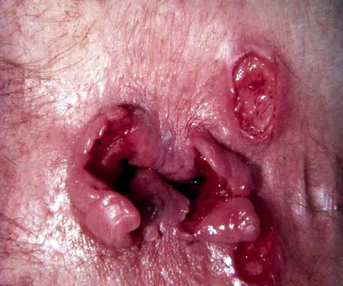 CROHN'S DISEASE