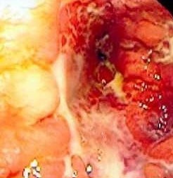 CROHN'S DISEASE